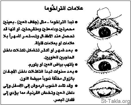 St-Takla.org Image: Trachoma     :  